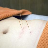 Acupuncture medecine chinoise